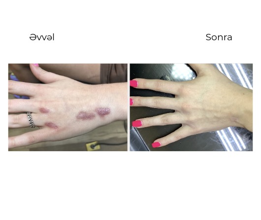 Candela Vbeam Perfecta